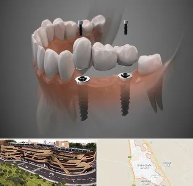 ایمپلنت دیجیتال در شاهین شهر