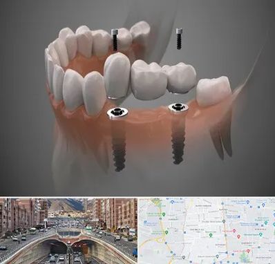 ایمپلنت دیجیتال در منطقه 10 تهران