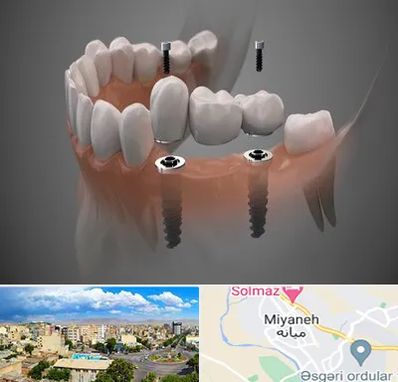 ایمپلنت دیجیتال در میانه