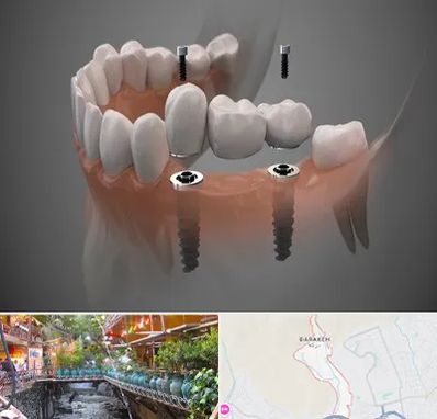 ایمپلنت دیجیتال در درکه