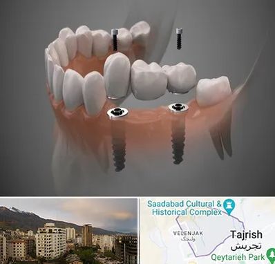 ایمپلنت دیجیتال در زعفرانیه 