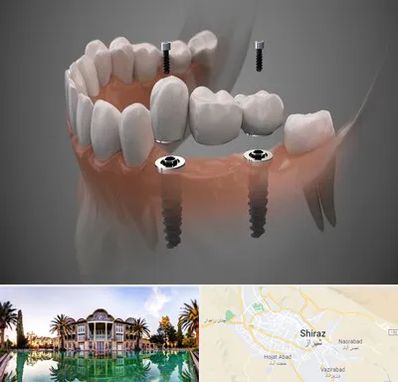 ایمپلنت دیجیتال در شیراز