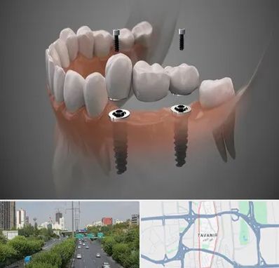 ایمپلنت دیجیتال در توانیر