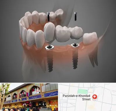 ایمپلنت دیجیتال در 15 خرداد