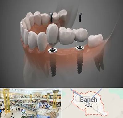 ایمپلنت دیجیتال در بانه