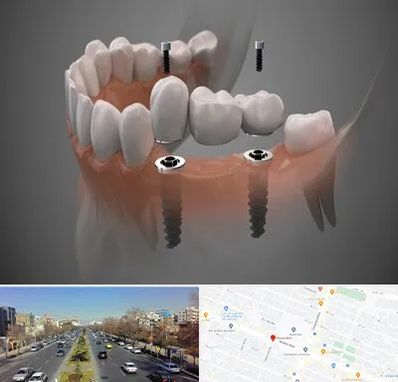 ایمپلنت دیجیتال در بلوار معلم مشهد