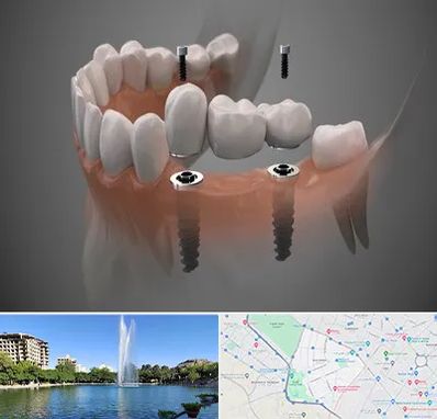 ایمپلنت دیجیتال در کوهسنگی مشهد