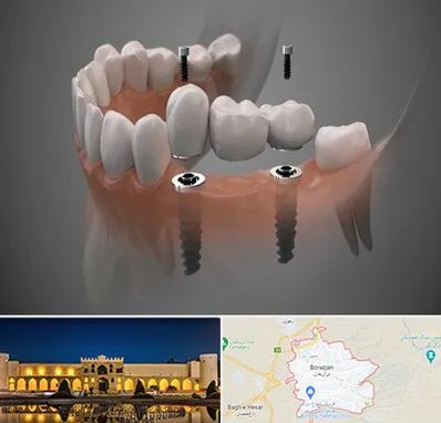 ایمپلنت دیجیتال در برازجان