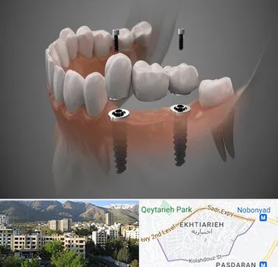 ایمپلنت دیجیتال در اختیاریه 