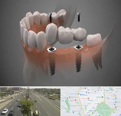 ایمپلنت دیجیتال در منطقه 17 تهران
