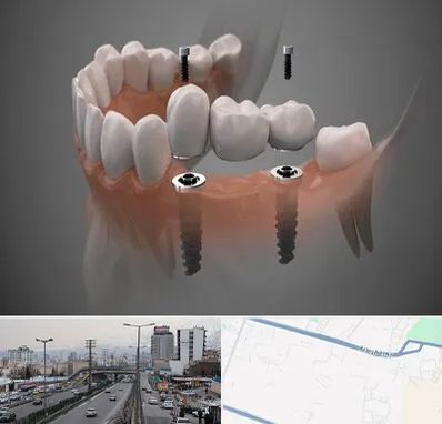 ایمپلنت دیجیتال در بلوار ارتش