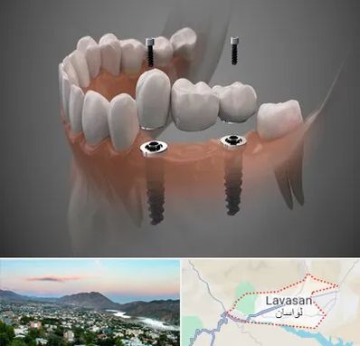 ایمپلنت دیجیتال در لواسان