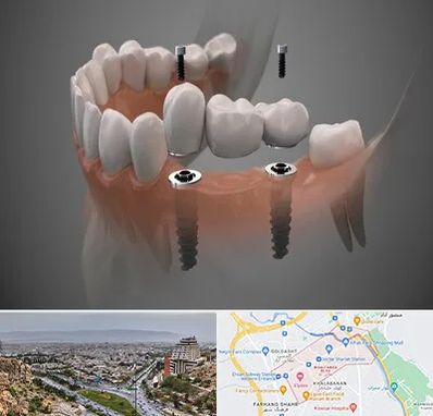 ایمپلنت دیجیتال در معالی آباد شیراز