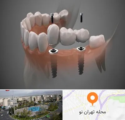 ایمپلنت دیجیتال در تهران نو