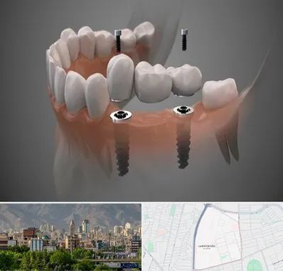 ایمپلنت دیجیتال در جمشیدیه