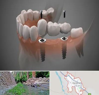 ایمپلنت دیجیتال در سراوان