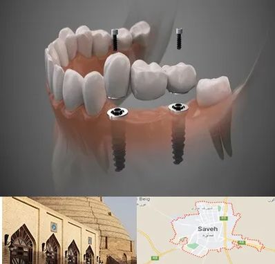ایمپلنت دیجیتال در ساوه