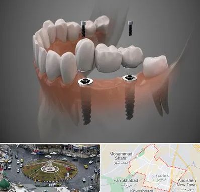 ایمپلنت دیجیتال در فردیس کرج 