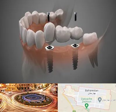 ایمپلنت دیجیتال در بهارستان