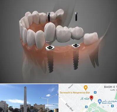 ایمپلنت دیجیتال در فلکه گاز شیراز