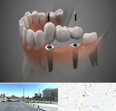 ایمپلنت دیجیتال در بلوار کلاهدوز مشهد