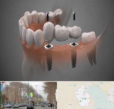 ایمپلنت دیجیتال در نظرآباد کرج