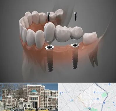 ایمپلنت دیجیتال در طلاب مشهد