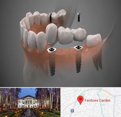 ایمپلنت دیجیتال در باغ فردوس
