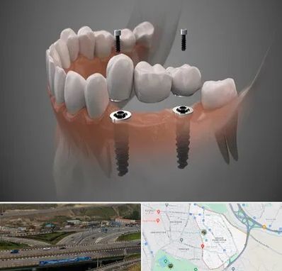 ایمپلنت دیجیتال در یاغچیان تبریز