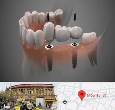 ایمپلنت دیجیتال در مولوی