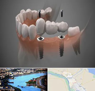 ایمپلنت دیجیتال در خرمشهر
