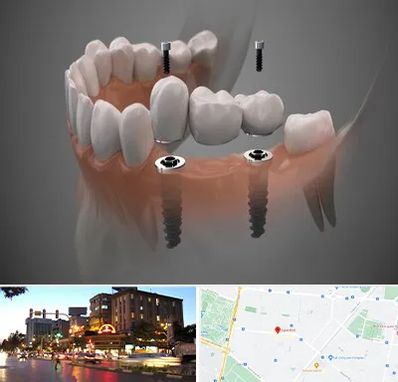 ایمپلنت دیجیتال در بلوار سجاد مشهد