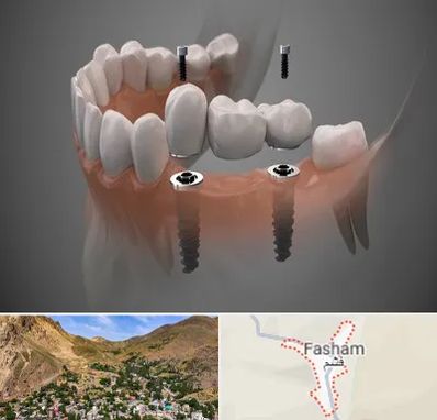 ایمپلنت دیجیتال در فشم