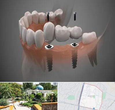 ایمپلنت دیجیتال در باغمیشه تبریز