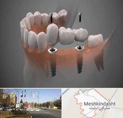 ایمپلنت دیجیتال در مشکین دشت