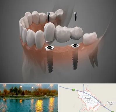 ایمپلنت دیجیتال در قروه