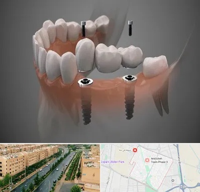 ایمپلنت دیجیتال در فاز سه اندیشه