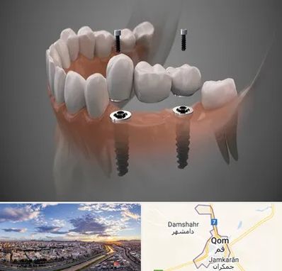 ایمپلنت دیجیتال در قم