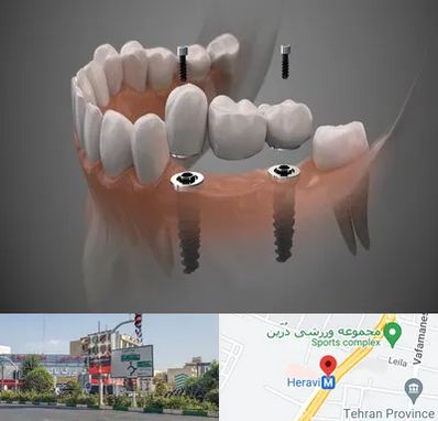 ایمپلنت دیجیتال در هروی 