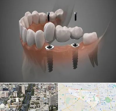 ایمپلنت دیجیتال در منطقه 18 تهران