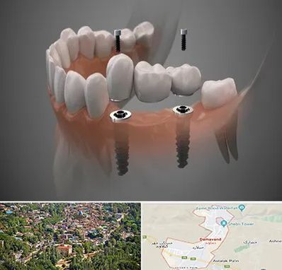 ایمپلنت دیجیتال در دماوند