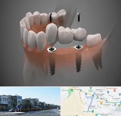 ایمپلنت دیجیتال در شریعتی مشهد