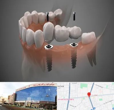 ایمپلنت دیجیتال در نصف راه تبریز
