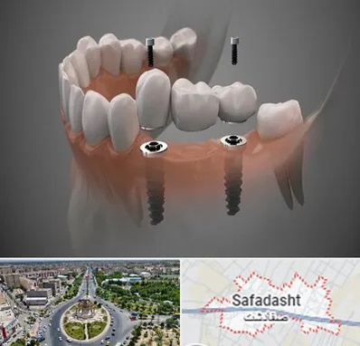 ایمپلنت دیجیتال در صفادشت