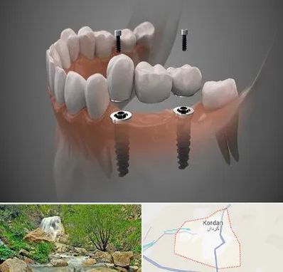 ایمپلنت دیجیتال در کردان