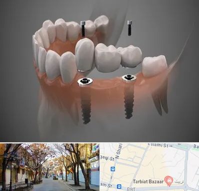 ایمپلنت دیجیتال در تربیت تبریز