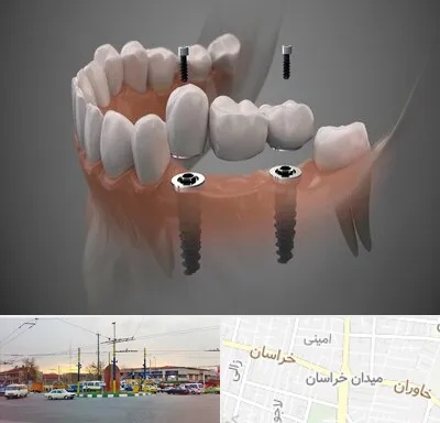 ایمپلنت دیجیتال در میدان خراسان