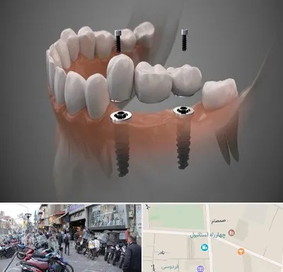 ایمپلنت دیجیتال در چهارراه استانبول