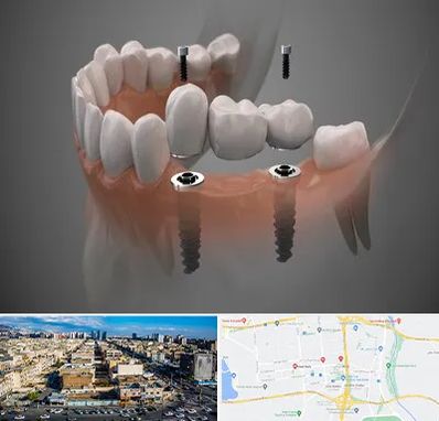 ایمپلنت دیجیتال در شهرک راه آهن