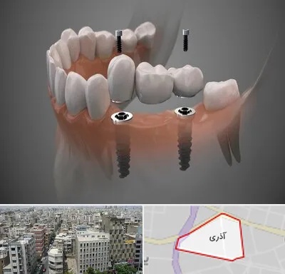 ایمپلنت دیجیتال در آذری